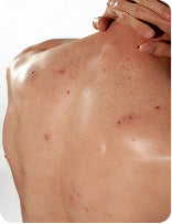 BODY ACNE