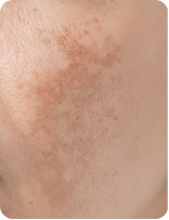 DARK SPOTS