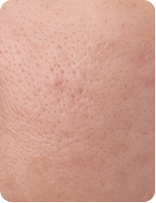 PORE CARE